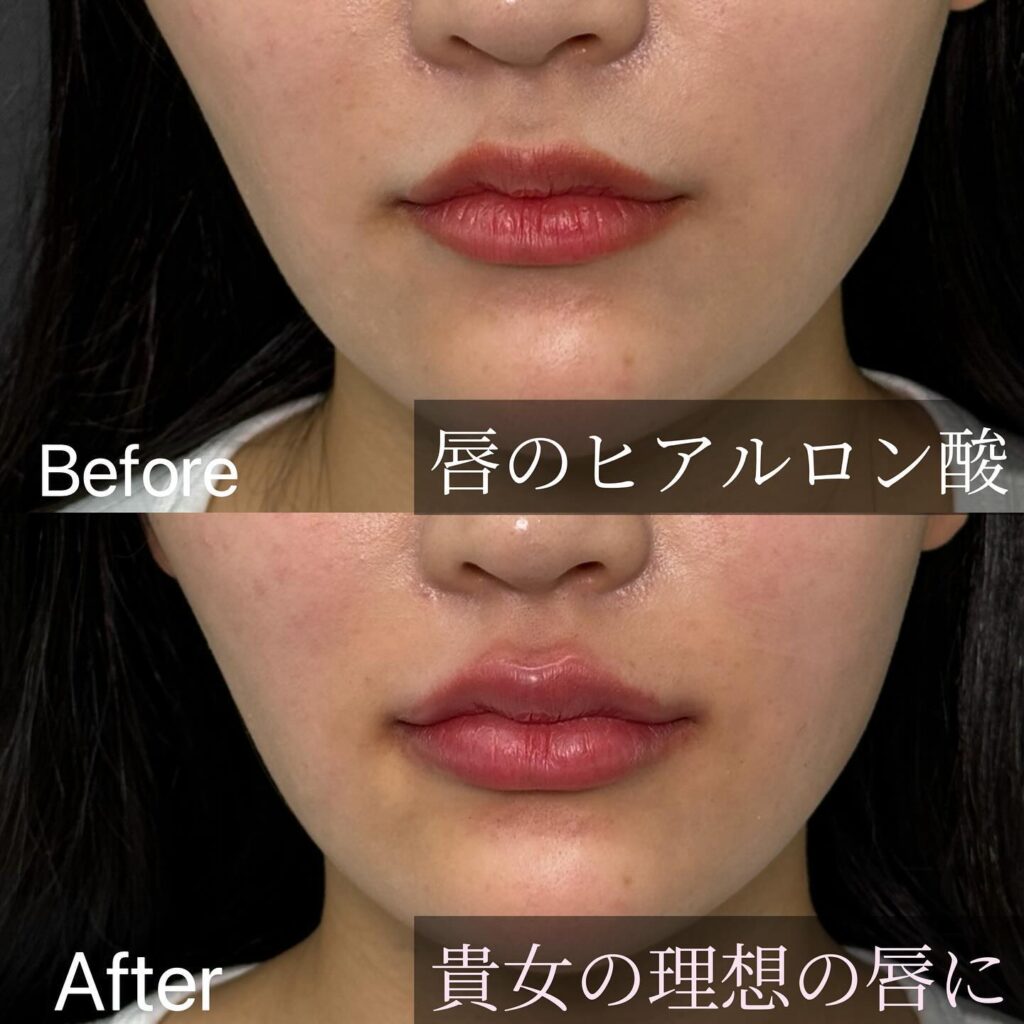 唇のヒアルロン酸の症例写真 (22)