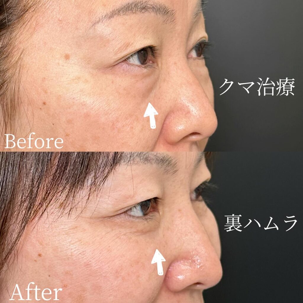 裏ハムラ法の症例写真 (46)