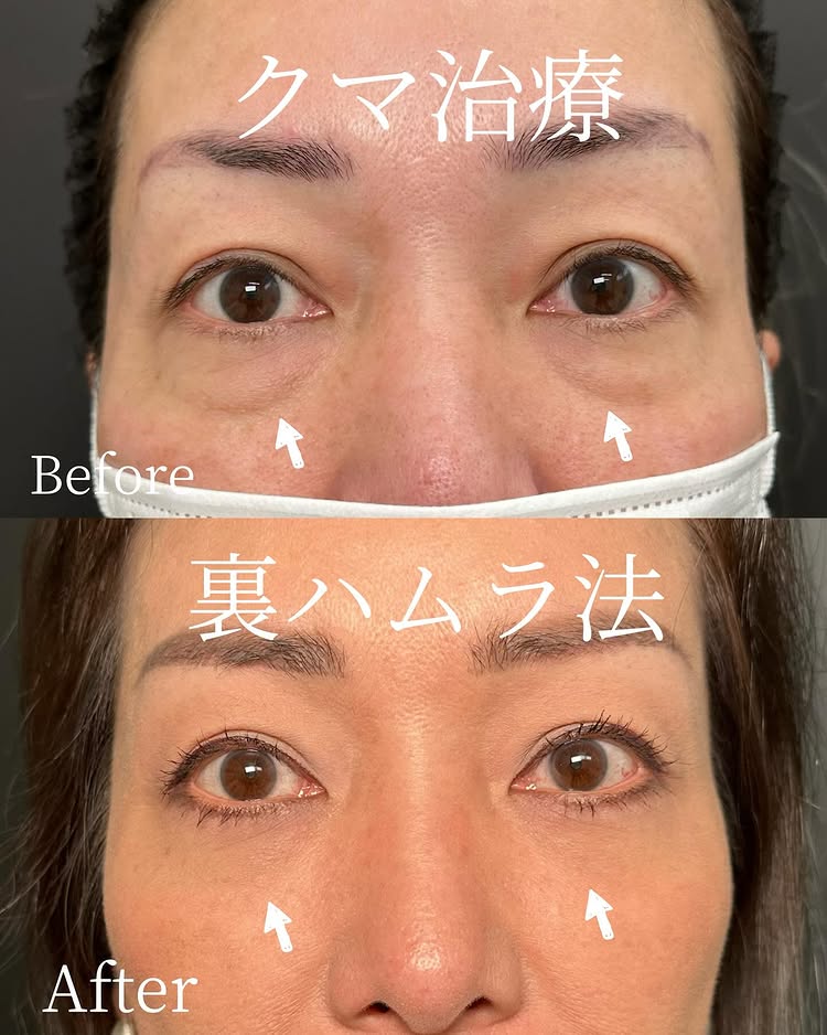 裏ハムラ法の症例写真 (79)