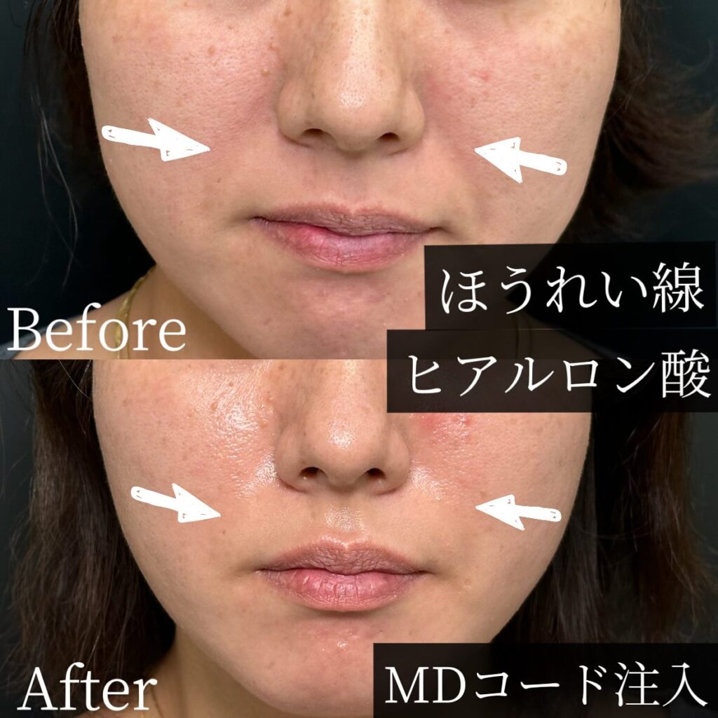 法令線のヒアルロン酸の症例写真 (15)