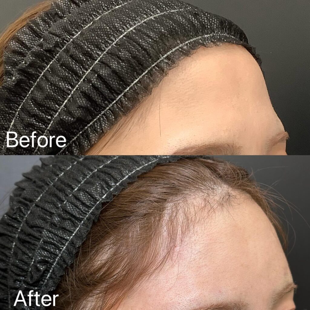 額のヒアルロン酸注入の症例写真 (2)