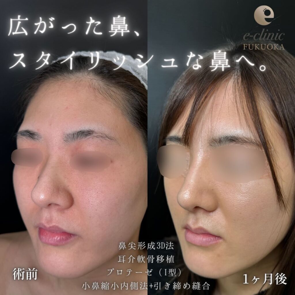 鼻尖形成と軟骨移植とプロテーゼと小鼻縮小の症例写真 (2)