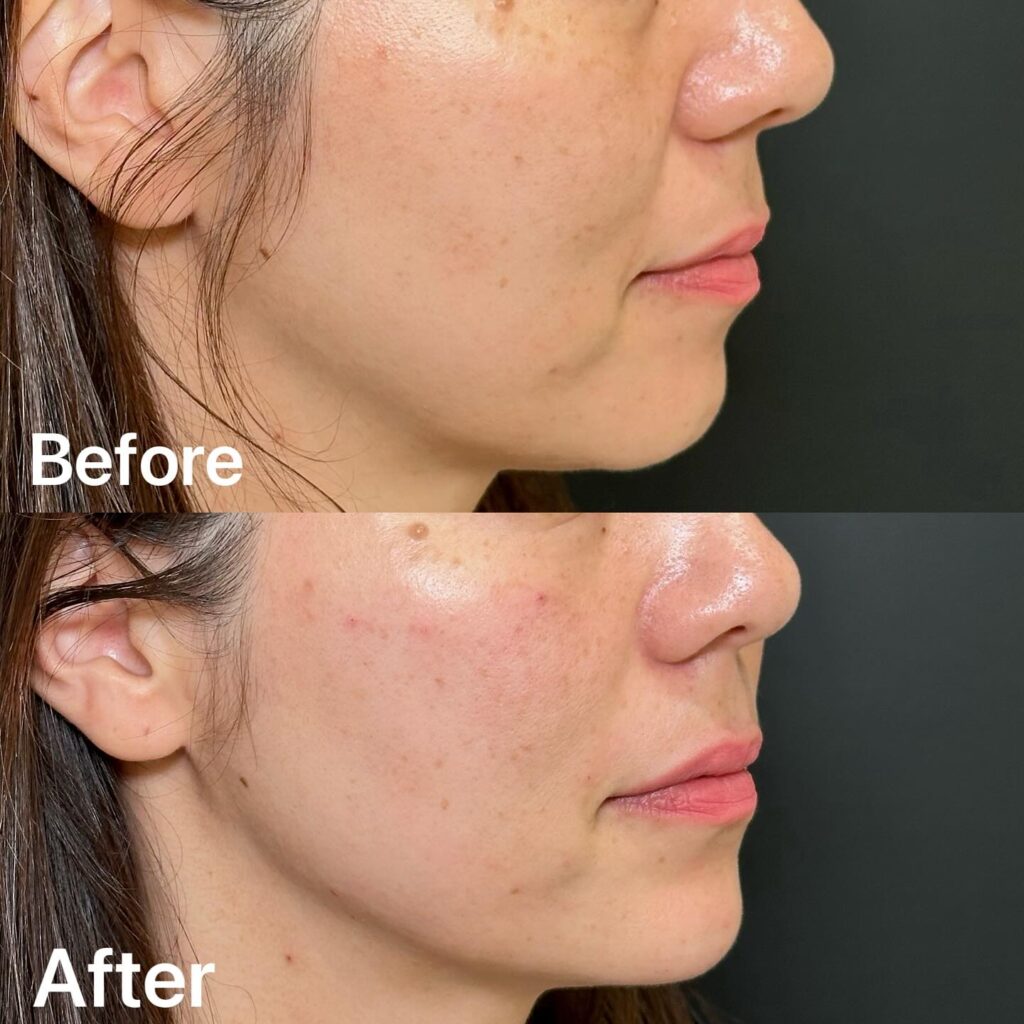 法令線のヒアルロン酸の症例 (2)