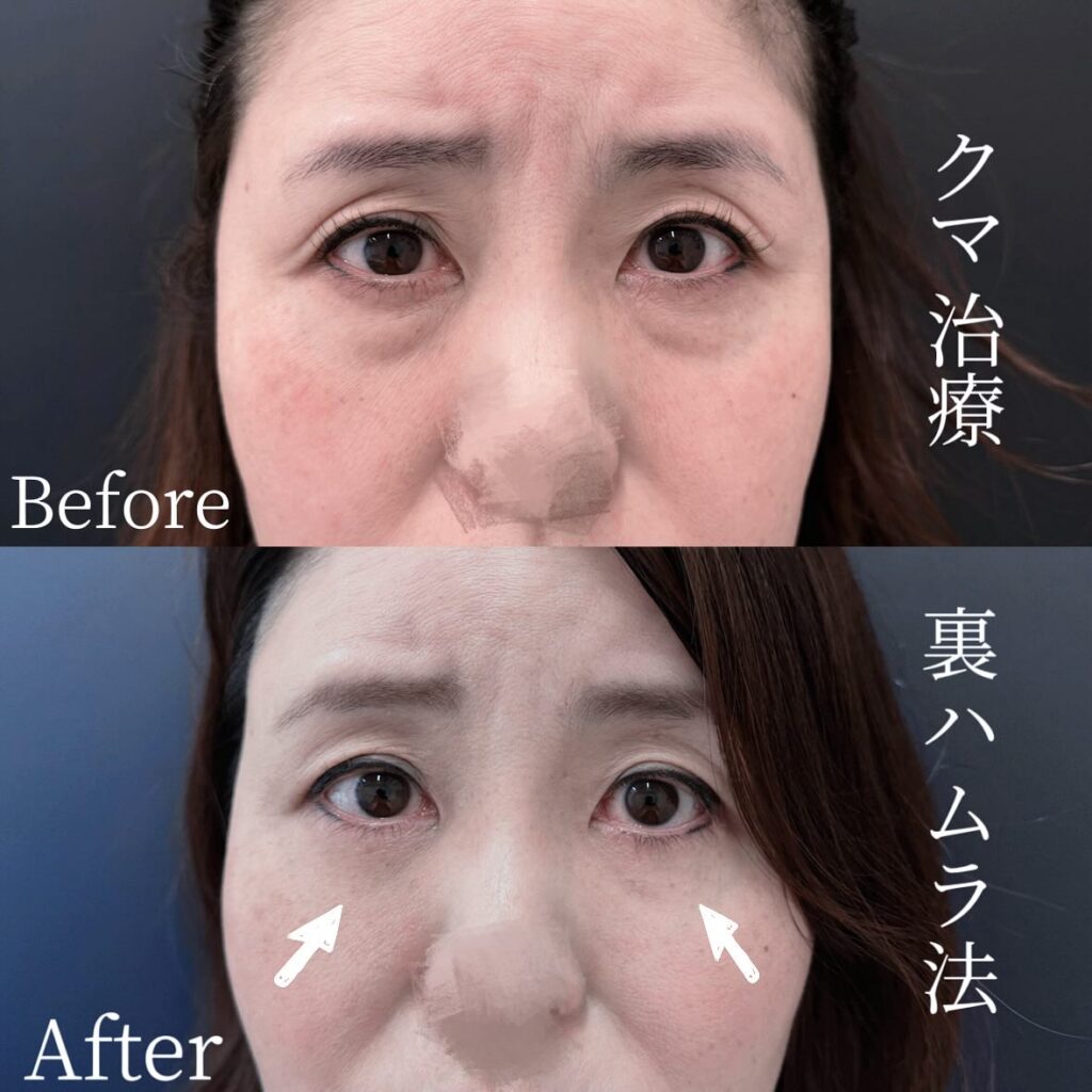 裏ハムラ法の症例写真 (29)