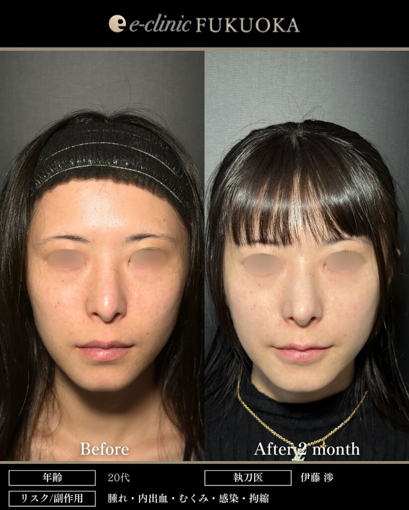 鼻尖形成と軟骨移植の症例写真 (25)