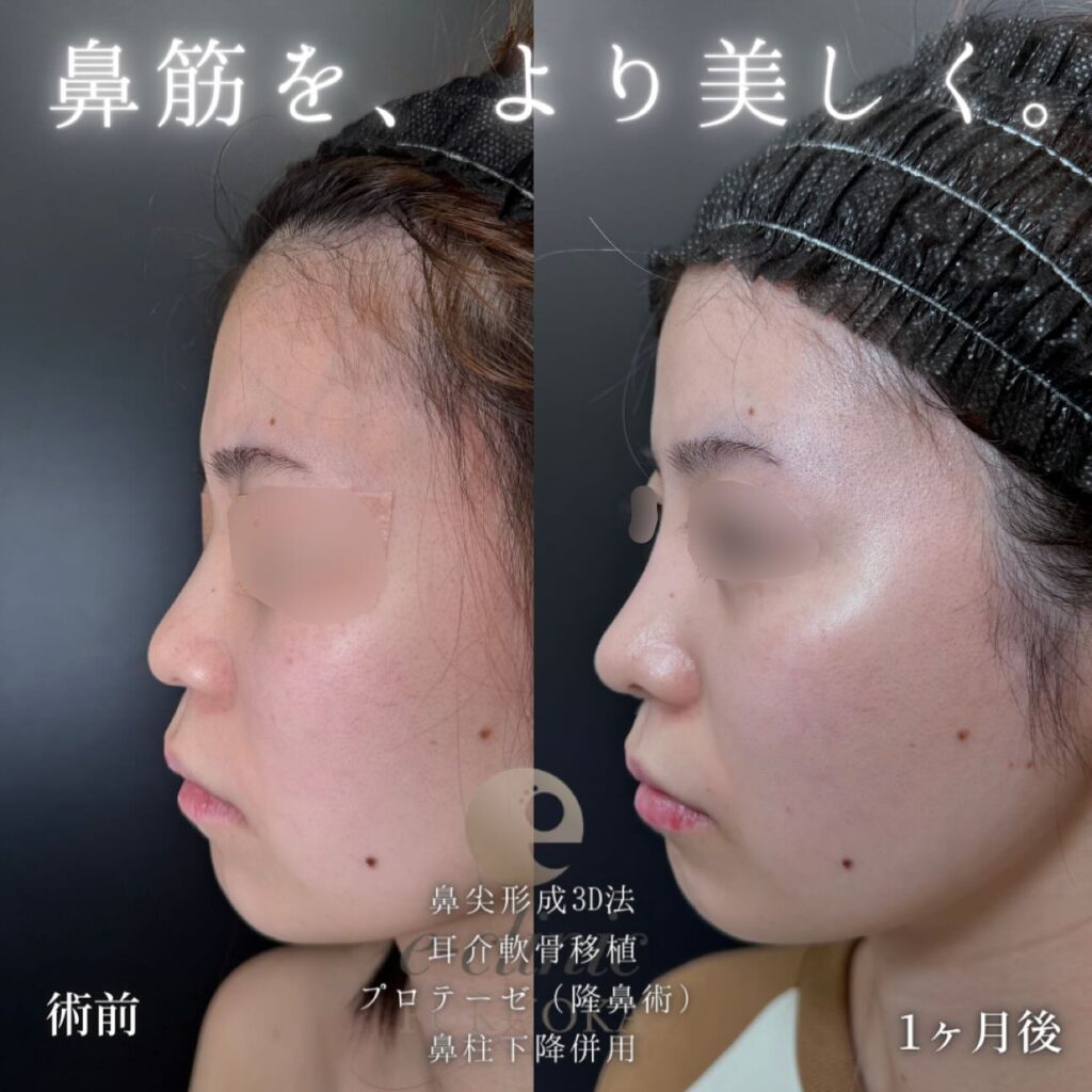 鼻尖形成と耳介軟骨移植とプロテーゼと鼻柱下降の症例写真 (2)