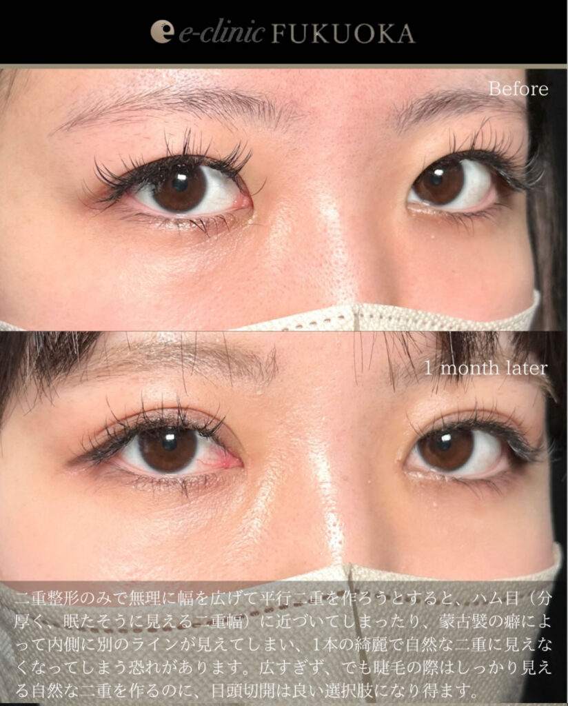 埋没法と目頭切開の症例写真2