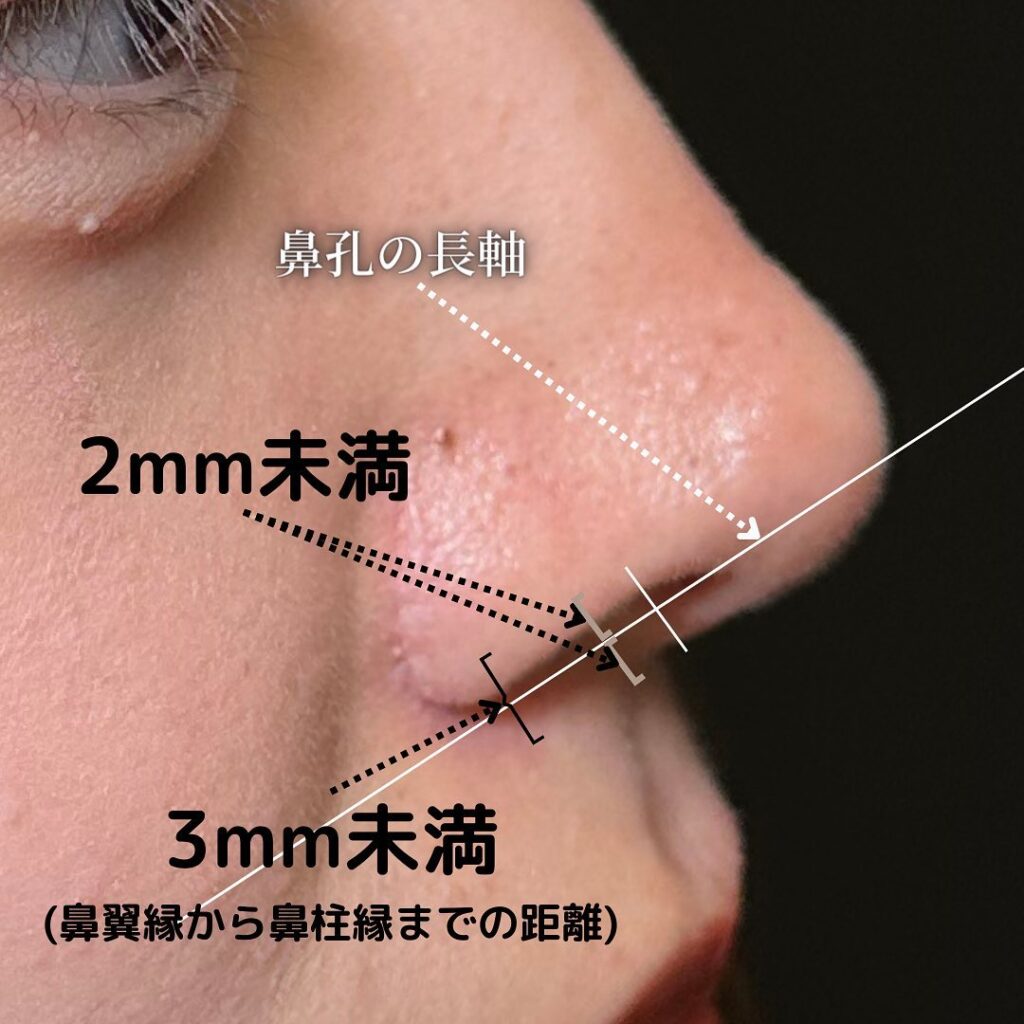 鼻中隔延長と鼻尖形成と耳介軟骨移植とプロテーゼと他院修正の症例写真 (5)