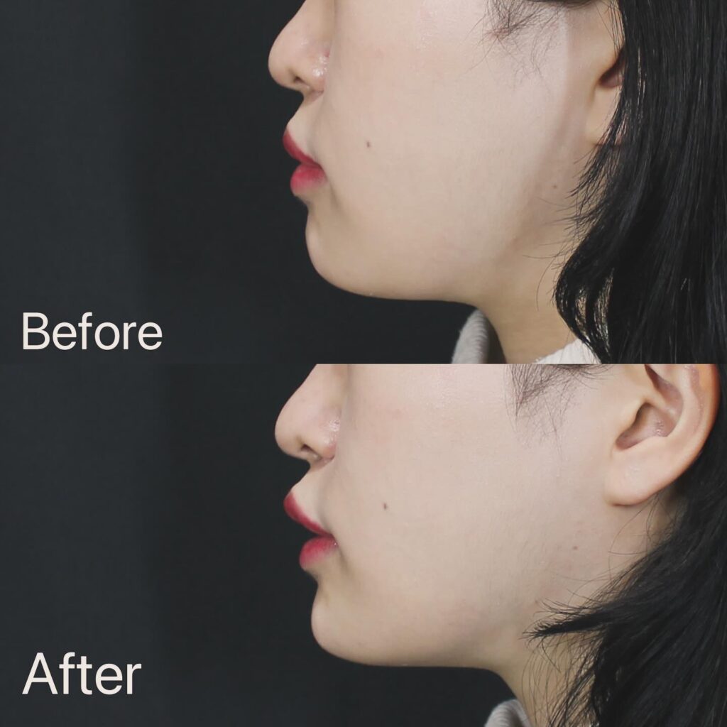 顎のヒアルロン酸の症例写真 (4)