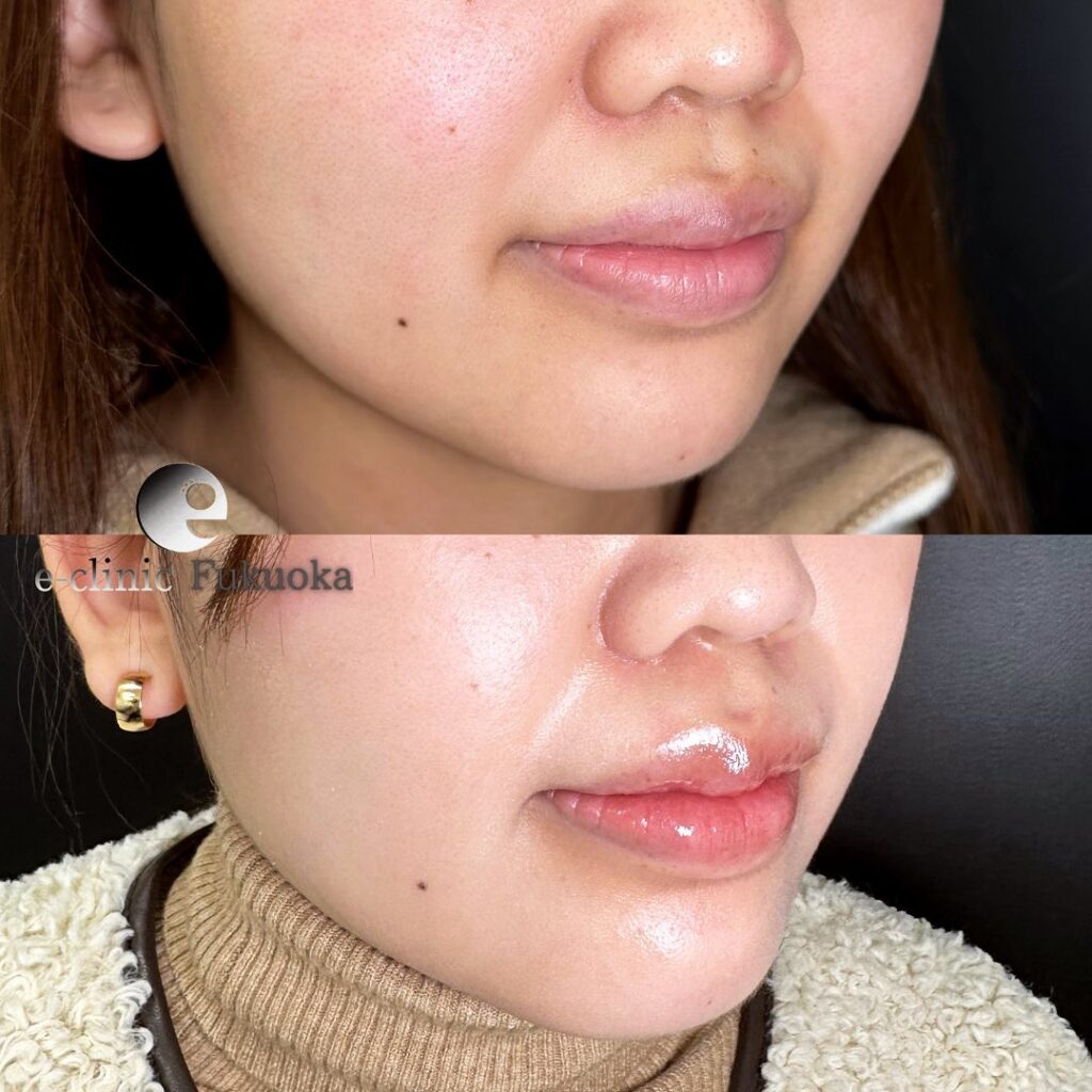 唇縮小の症例写真 (2)