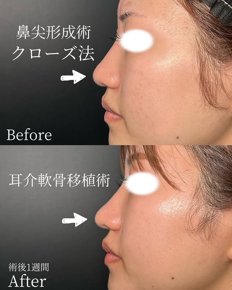 鼻尖形成と軟骨移植の症例写真 (19)
