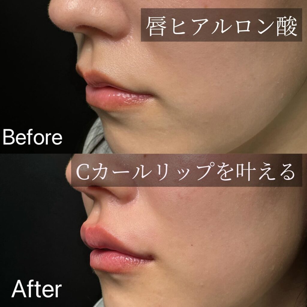 唇のヒアルロン酸 (1)