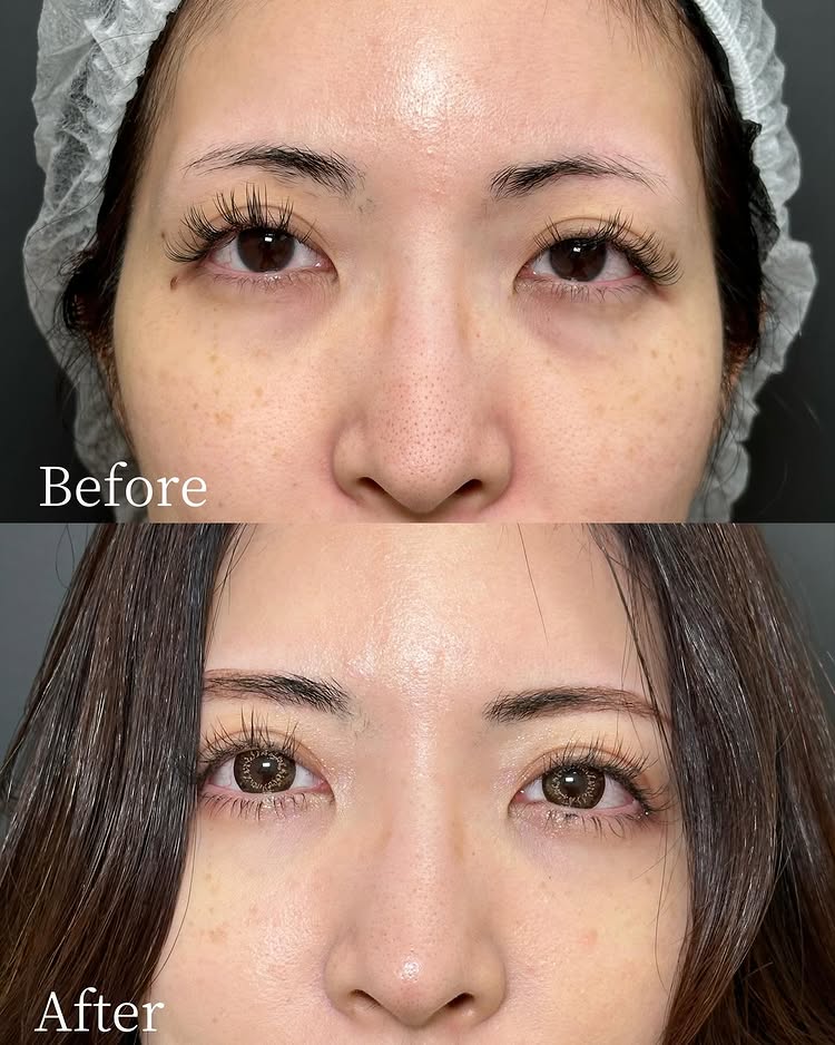 裏ハムラ法の症例写真 (86)