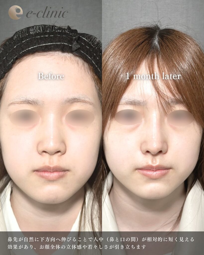 鼻尖形成と鼻中隔延長と耳介軟骨移植とプロテーゼと小鼻縮小の症例写真 (4)