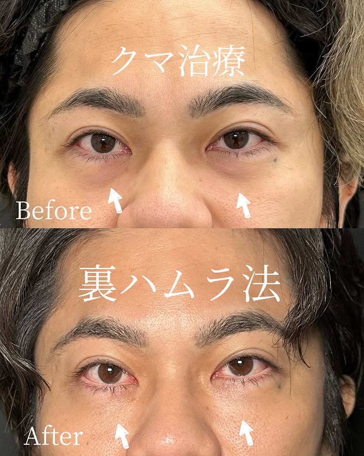 裏ハムラ法の症例写真 (71)