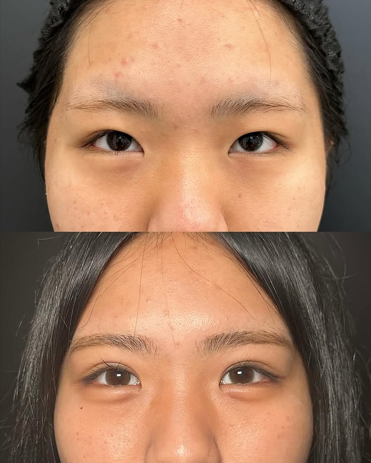 埋没法の症例写真 (10)