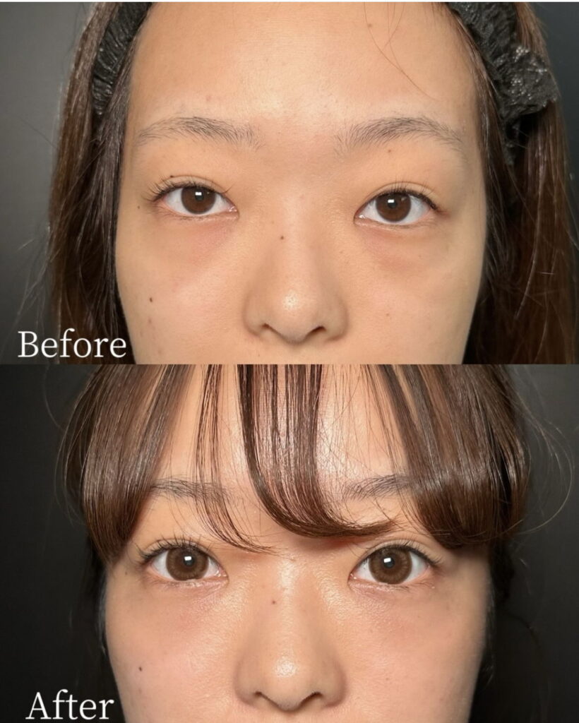 裏ハムラ法の症例写真 (2)