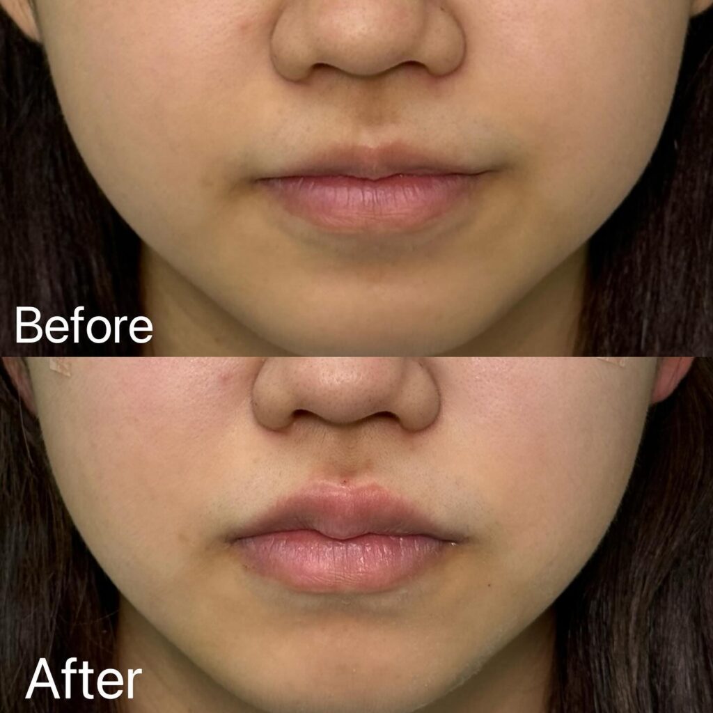 唇のヒアルロン酸 (4)