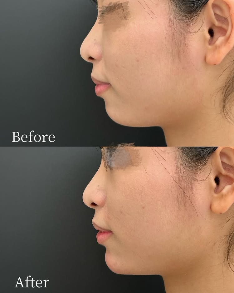 顎のヒアルロン酸の症例写真 (28)