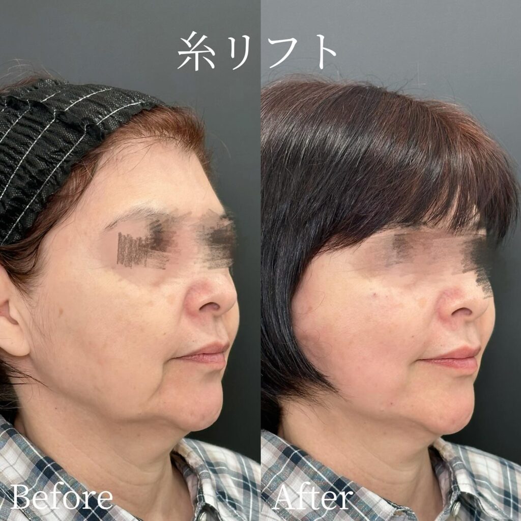 糸リフトの症例写真 (34)