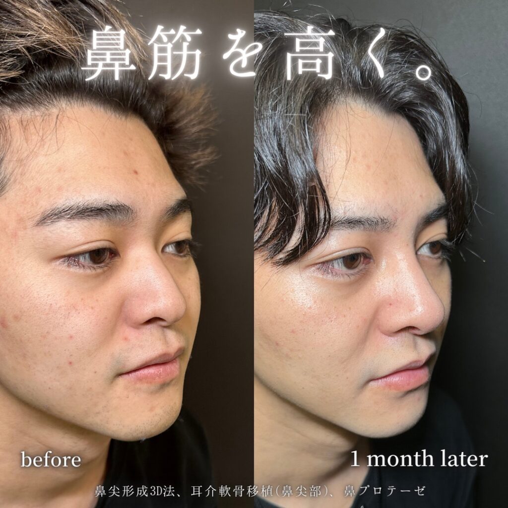 鼻尖形成と軟骨移植とプロテーゼの症例写真 (4)