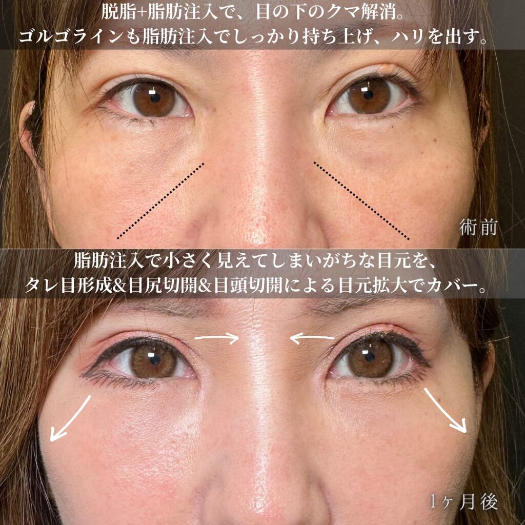 目の全方向拡大とクマ取りの症例写真 (6)