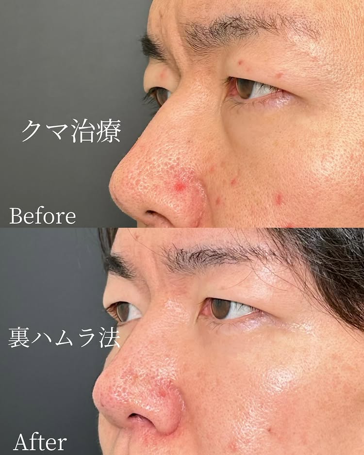 裏ハムラ法の症例写真 (49)