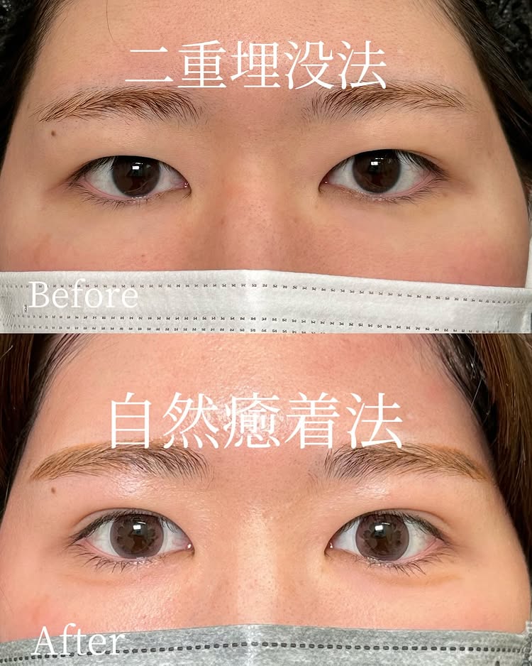 自然癒着法の症例写真 (15)