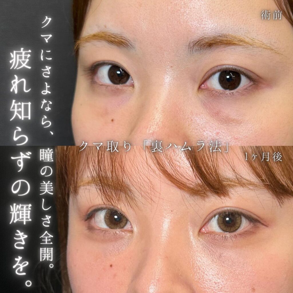 裏ハムラ法の症例写真 (37)