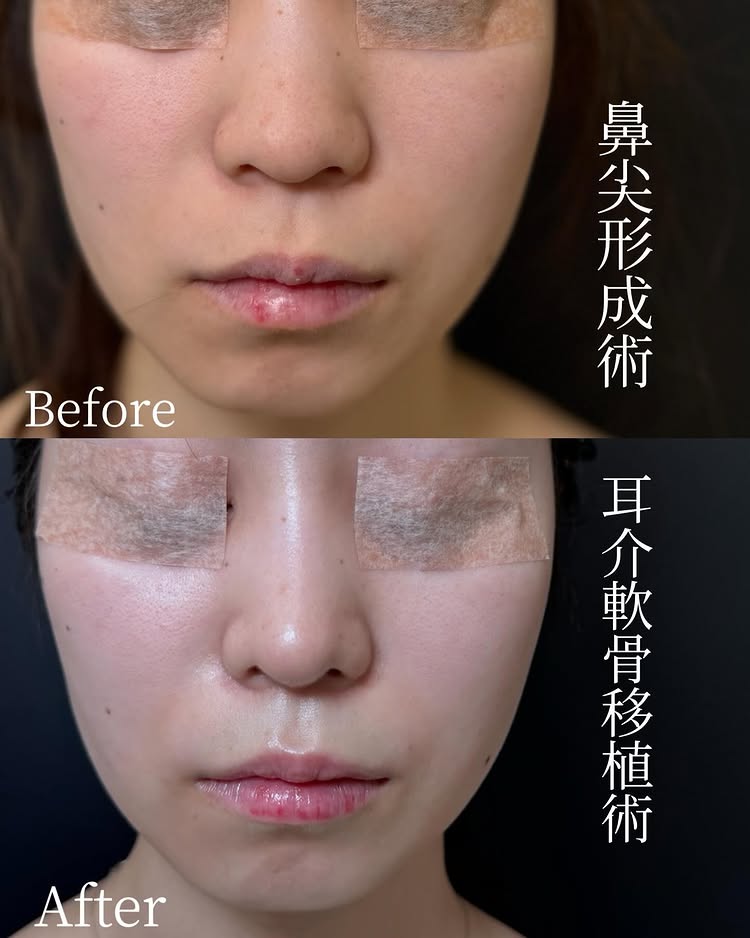 鼻尖形成と軟骨移植の症例写真 (7)