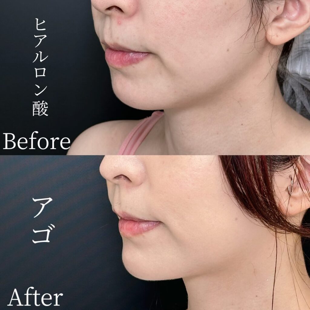 顎のヒアルロン酸の症例写真 (13)