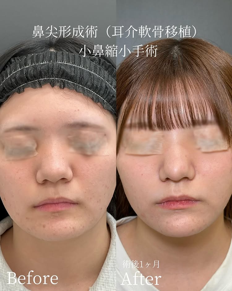 鼻尖形成と小鼻縮小の症例写真