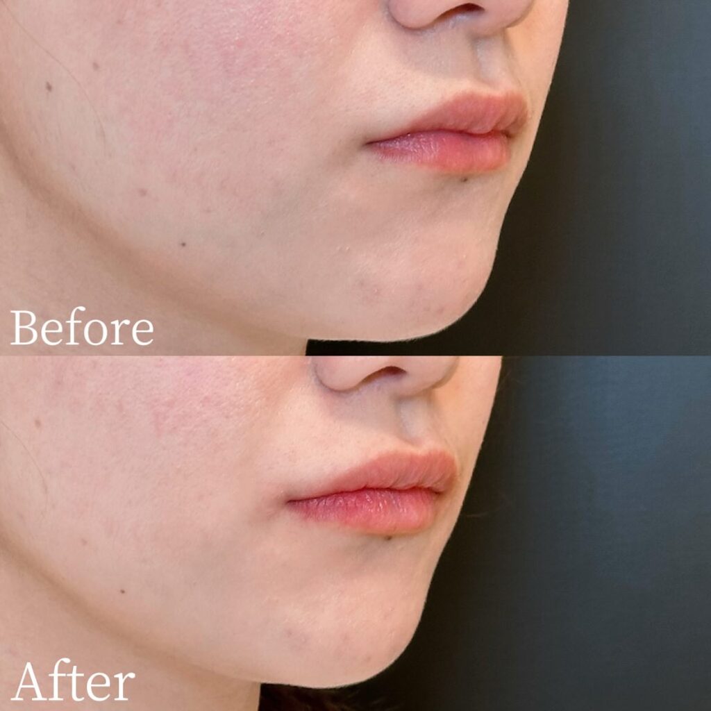 唇のヒアルロン酸の症例写真 (31)