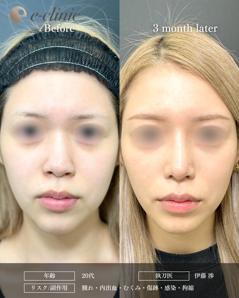 鼻尖形成と軟骨移植とプロテーゼと小鼻縮小の症例写真 (12)