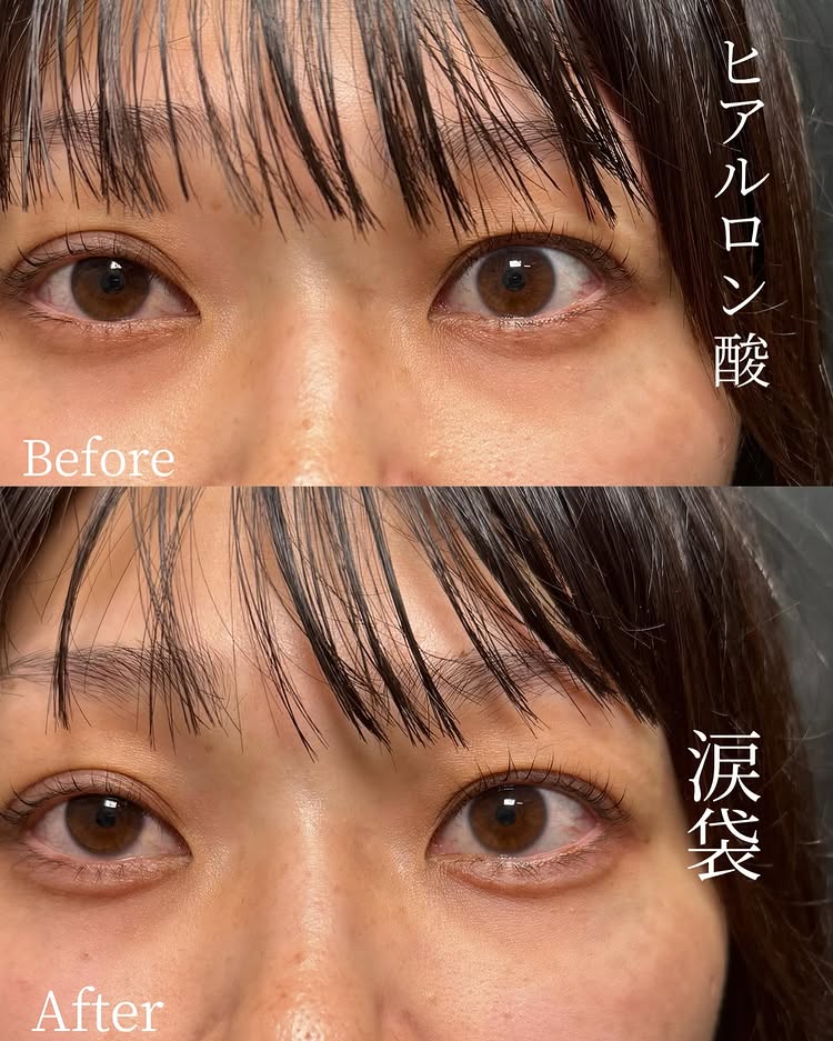 涙袋のヒアルロン酸の症例写真 (9)