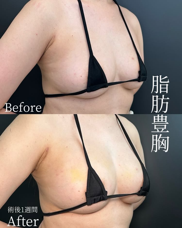 脂肪豊胸の症例写真 (3)