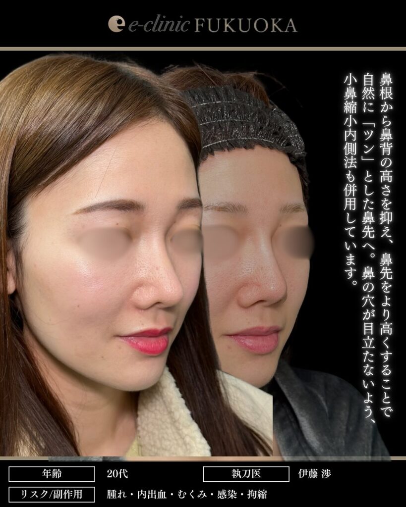 鼻尖形成と軟骨移植と小鼻縮小とプロテーゼと貴族手術の症例写真 (3)