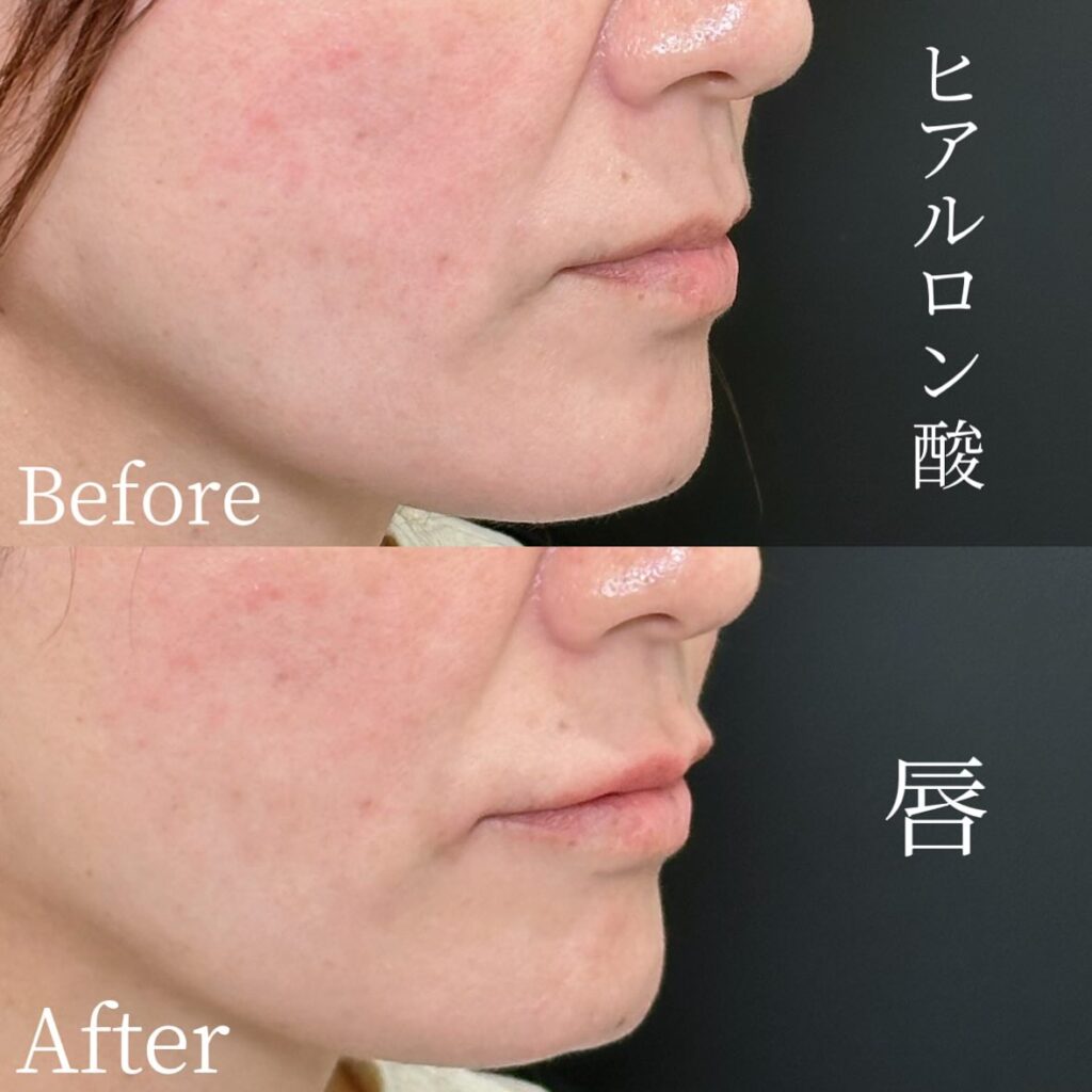 唇のヒアルロン酸の症例写真 (29)