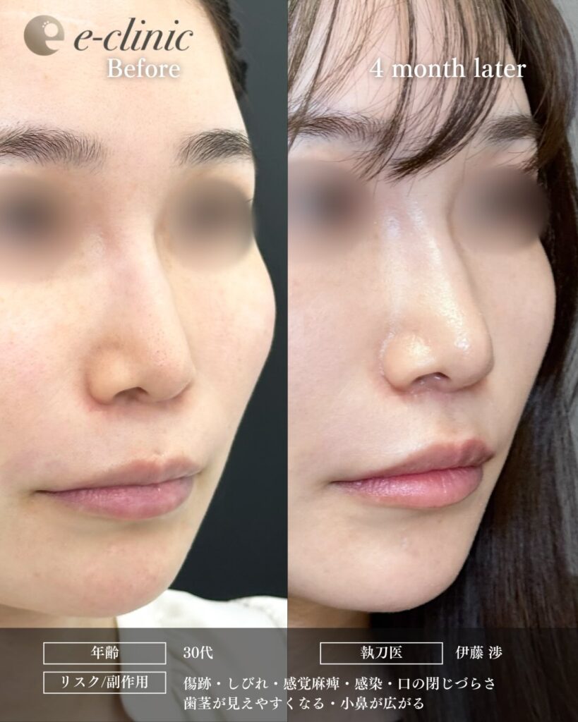 人中短縮の症例写真 (31)