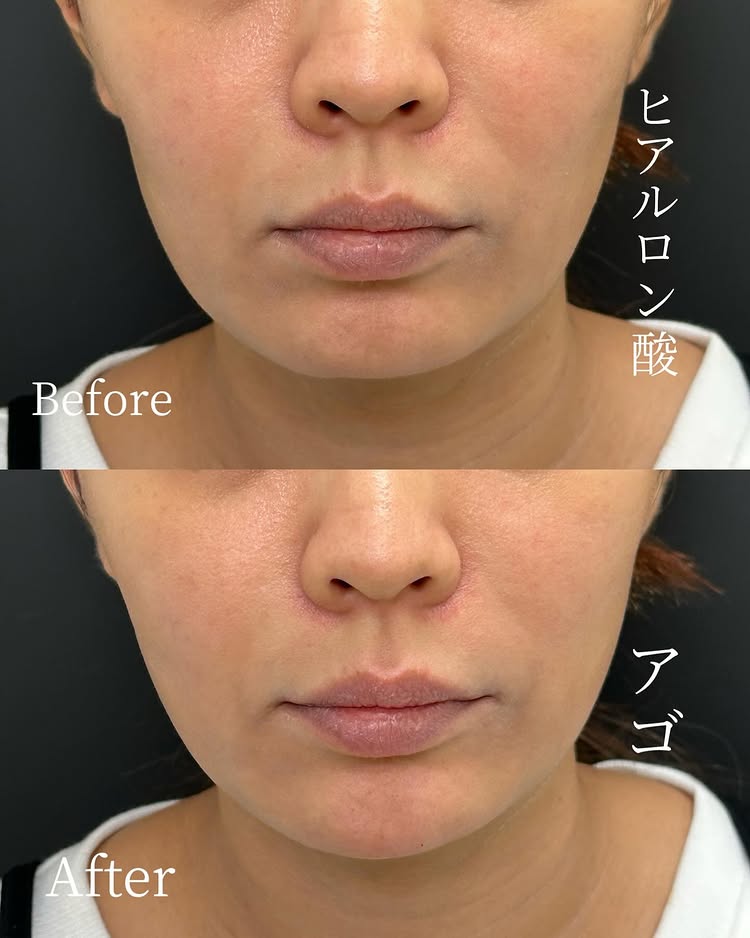 顎のヒアルロン酸の症例写真 (20)