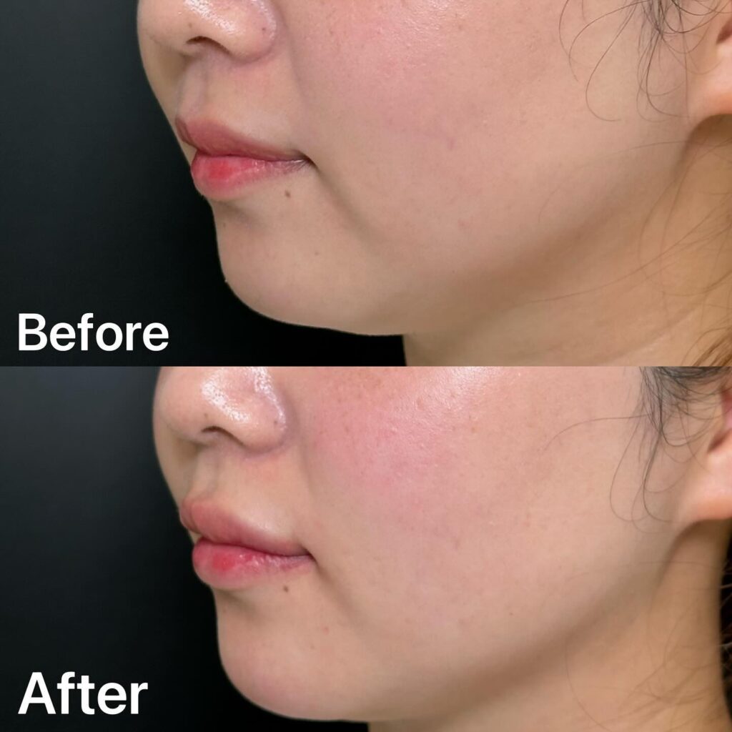 唇のヒアルロン酸の症例写真 (25)