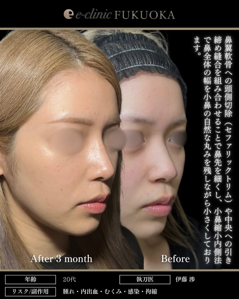 鼻尖形成と軟骨移植と小鼻縮小とプロテーゼの症例写真 (10)