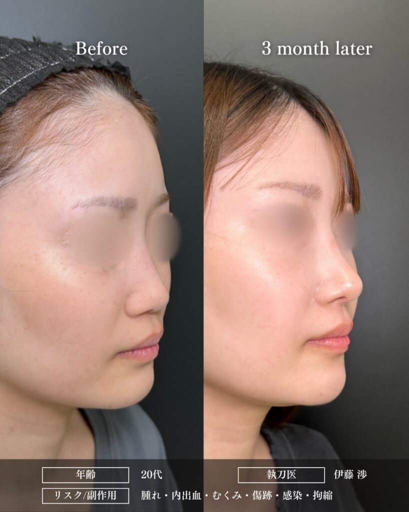 鼻中隔延長と鼻尖形成と軟骨移植とプロテーゼの症例写真 (12)