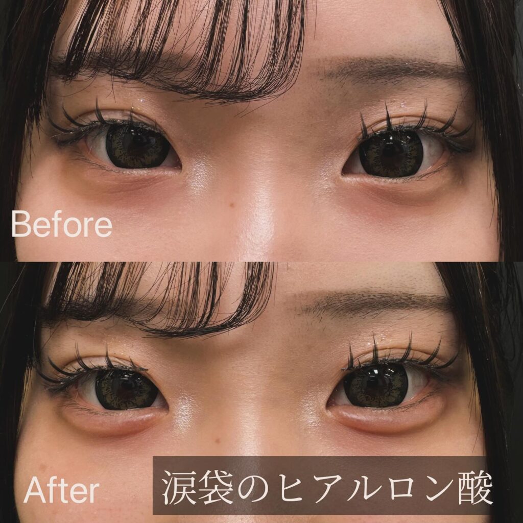 涙袋のヒアルロン酸の症例写真 (3)