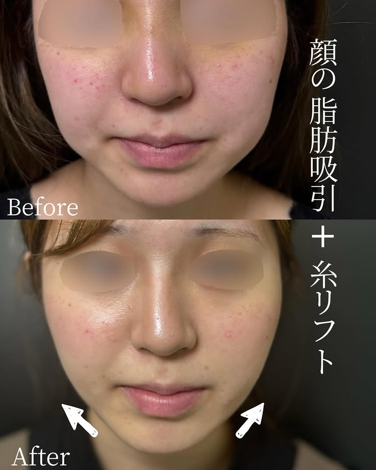 頬と顎下の脂肪吸引と糸リフトの症例写真 (2)