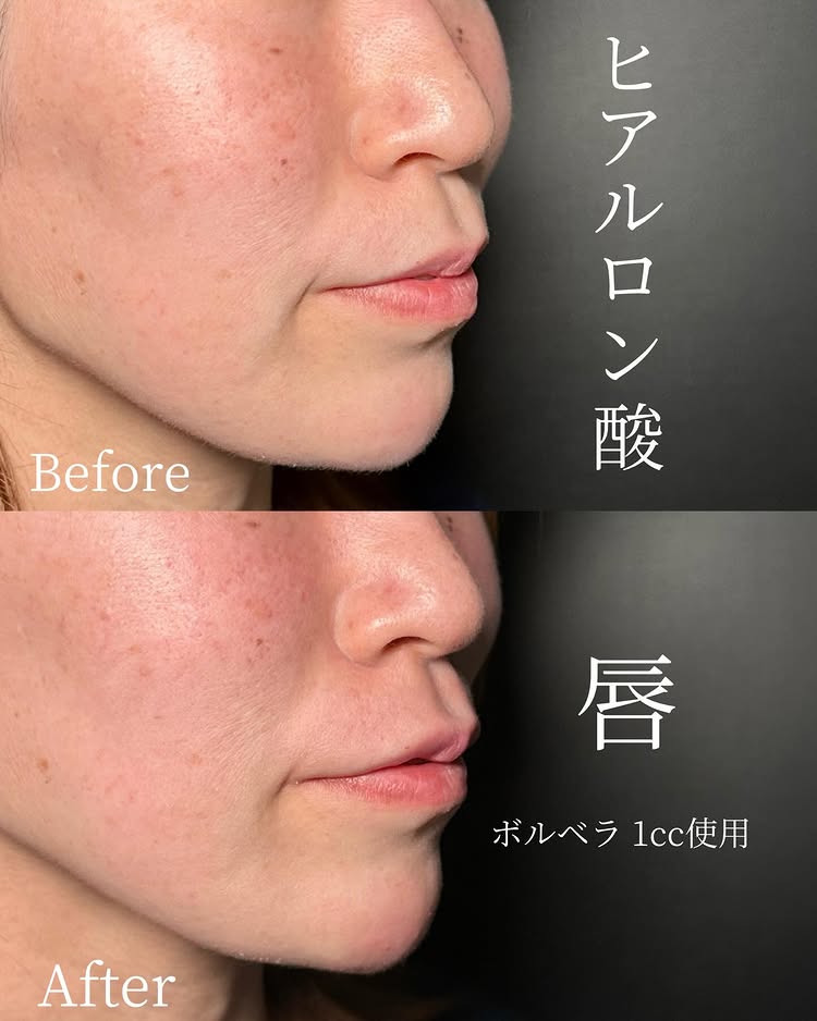 唇のヒアルロン酸の症例写真 (56)