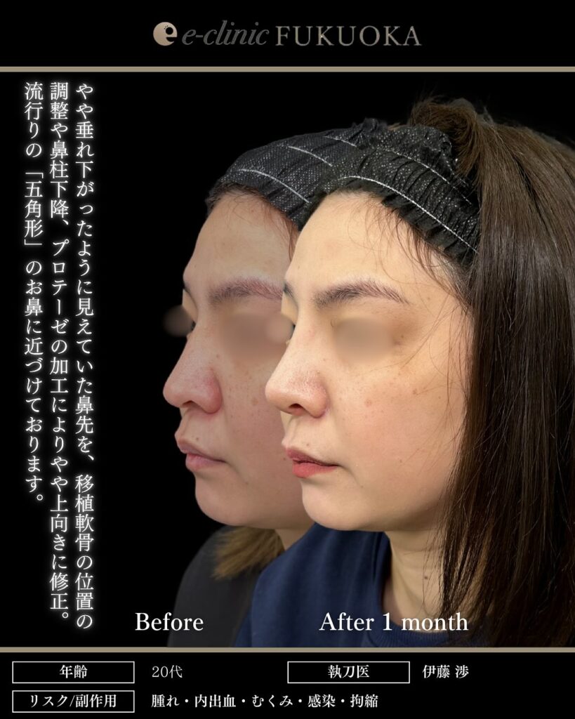 鼻尖形成と耳介軟骨移植と鼻柱下降とプロテーゼと小鼻縮小の症例写真 (4)