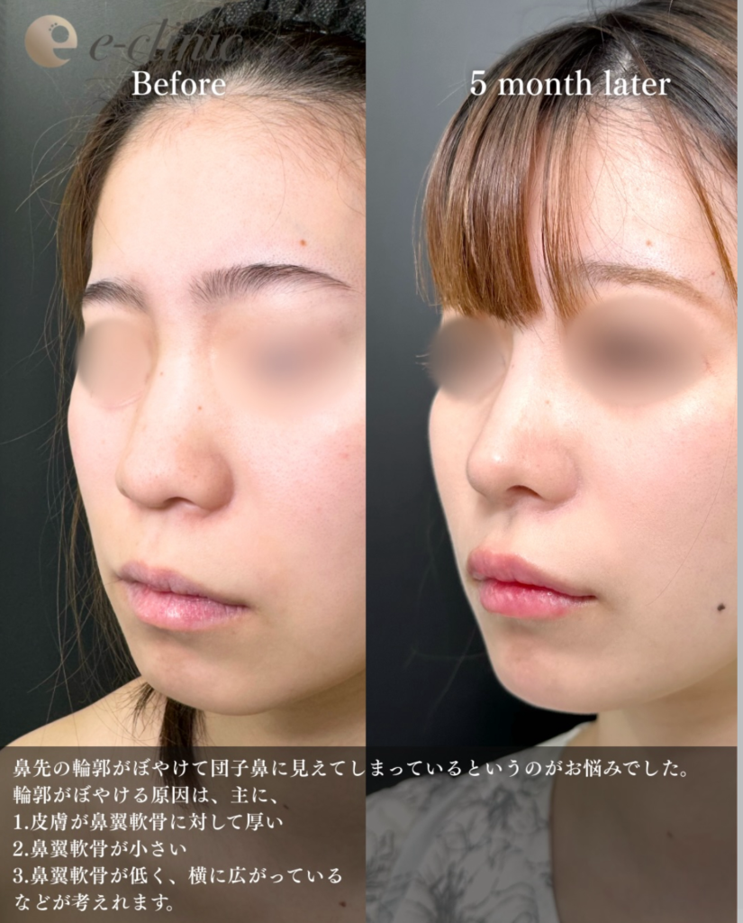 鼻尖形成と軟骨移植と鼻柱下降とプロテーゼの症例写真 (2)