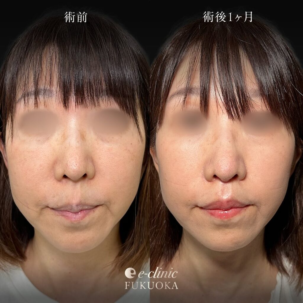 人中短縮の症例写真 (11)