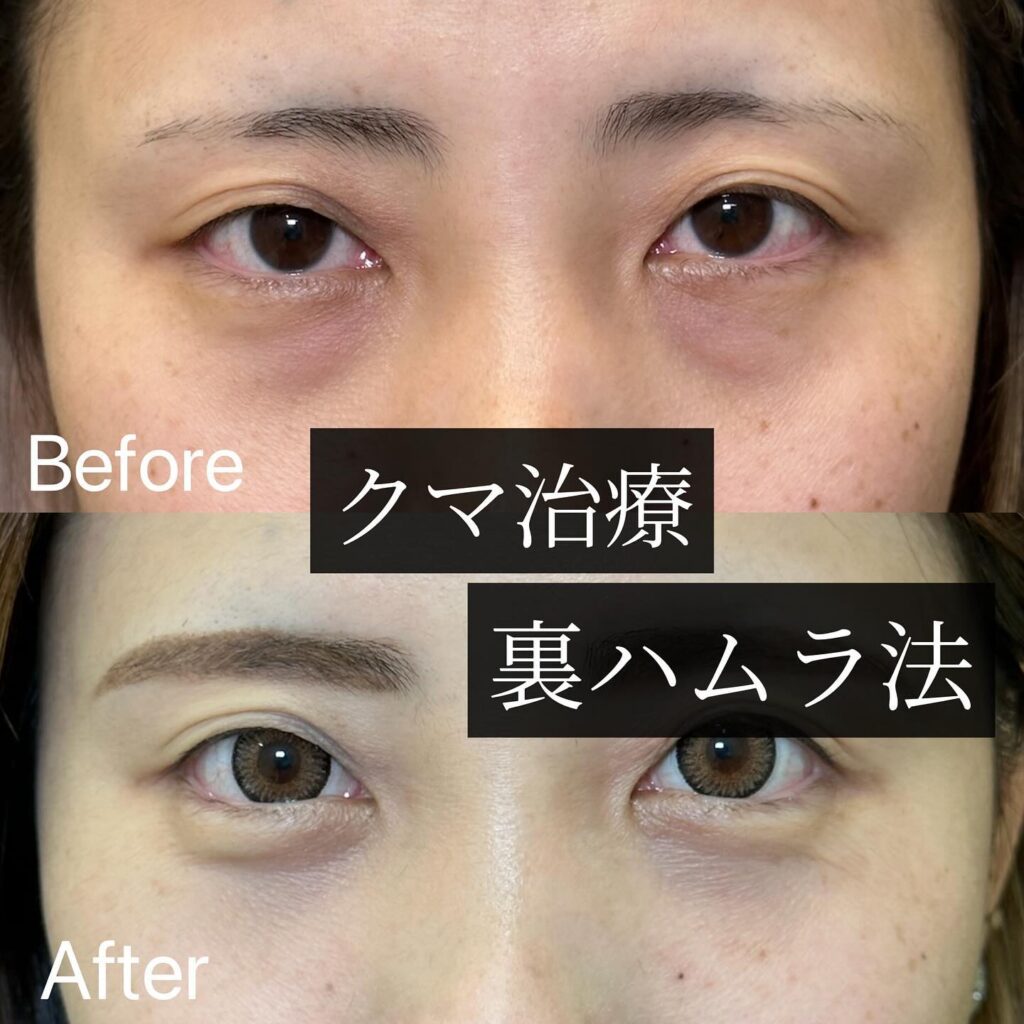 裏ハムラ法の症例写真 (19)